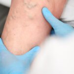 Varices: Todo lo que Necesitas Saber sobre Causas, Síntomas, Tratamientos y Prevención